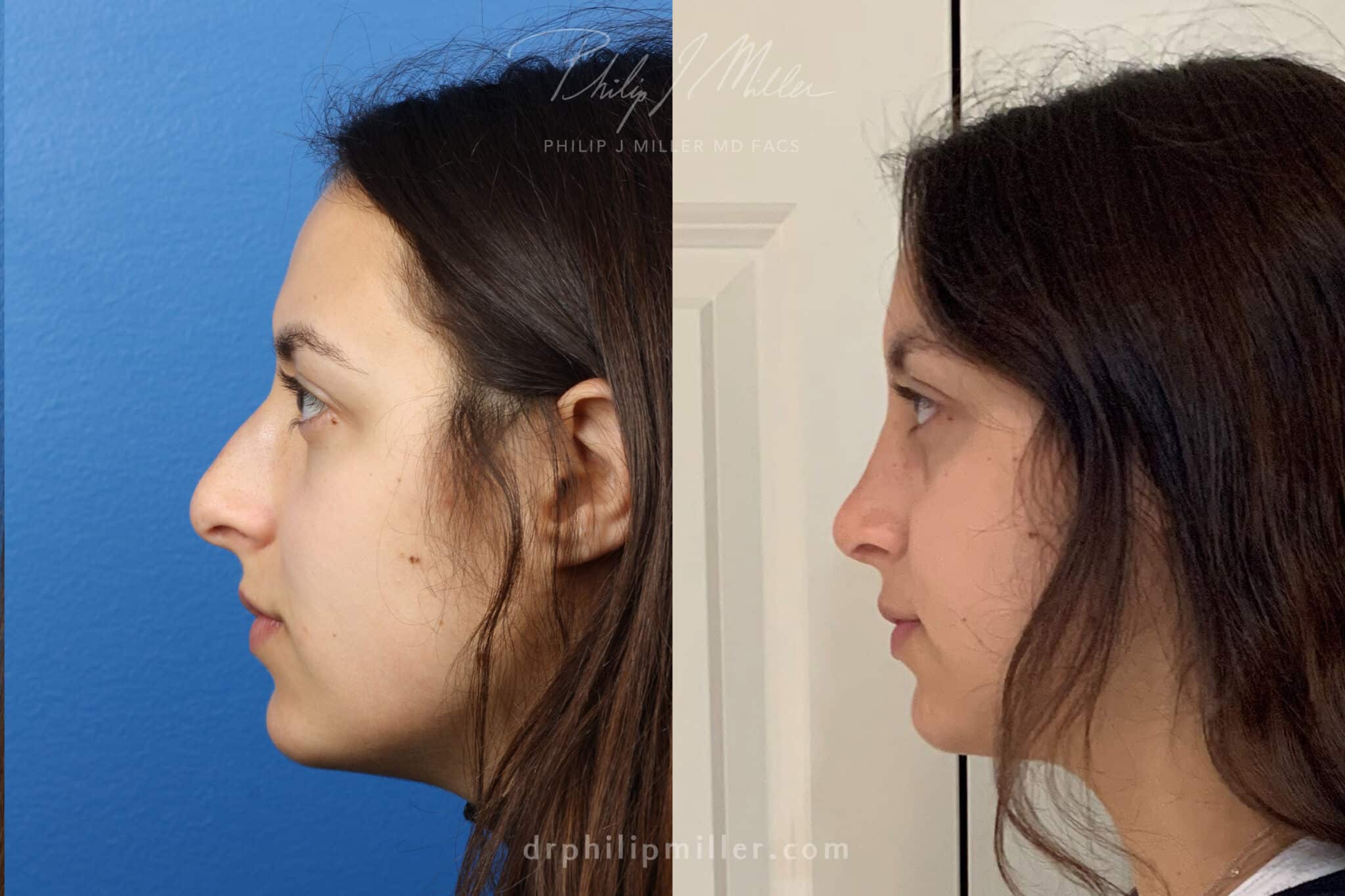 rhinoplasty before and after photos in new york