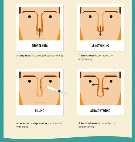 Rhinoplasty treatment infographic by Dr. Philip Miller in New York