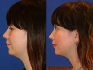 Neck liposuction to eliminate submental fat and improve the profile of a female patient by Dr. Miller. Surgery creates a smoother transition from the chin to the neck in NYC, NY