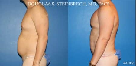 Body banking, fat transfer to shoulder and pecs by Dr. Steinbrech