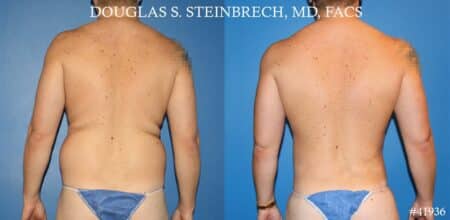 Body banking, fat transfer to shoulder and pecs by Dr. Steinbrech