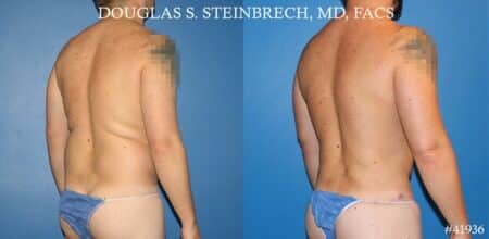 Body banking, fat transfer to shoulder and pecs by Dr. Steinbrech