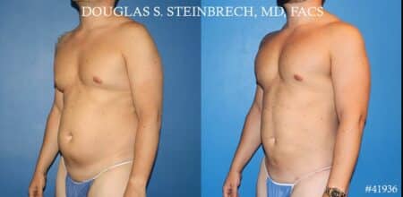 Body banking, fat transfer to shoulder and pecs by Dr. Steinbrech