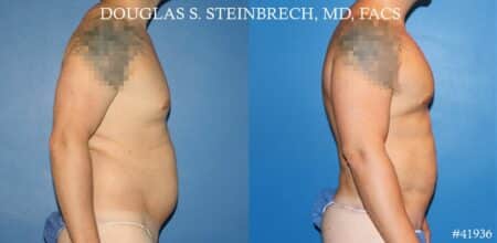 Body banking, fat transfer to shoulder and pecs by Dr. Steinbrech