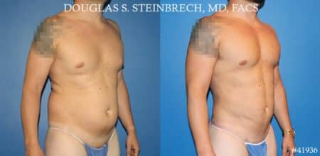 Body banking, fat transfer to shoulder and pecs by Dr. Steinbrech