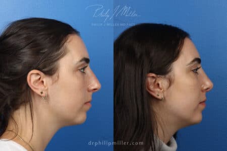 Rhinoplasty to improve nasal bridge and tip, 3 month post-op, by Dr. Miller