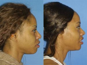Image of African American woman after african american rhinoplasty in NYC, NY