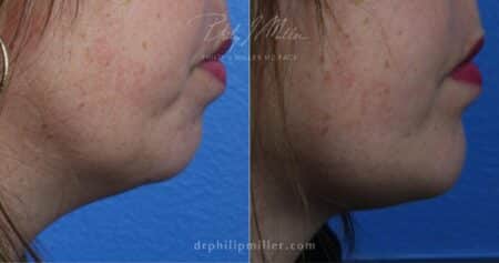 Chin implant to strengthen chin and improve profile by Dr. Miller