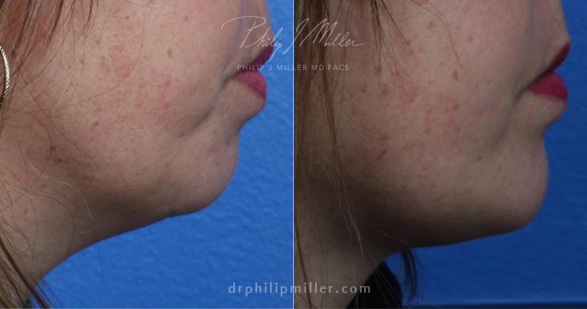 Chin implant to strengthen chin and improve profile by Dr. Miller. After surgery, chin is more defined and profile is more proportionate.