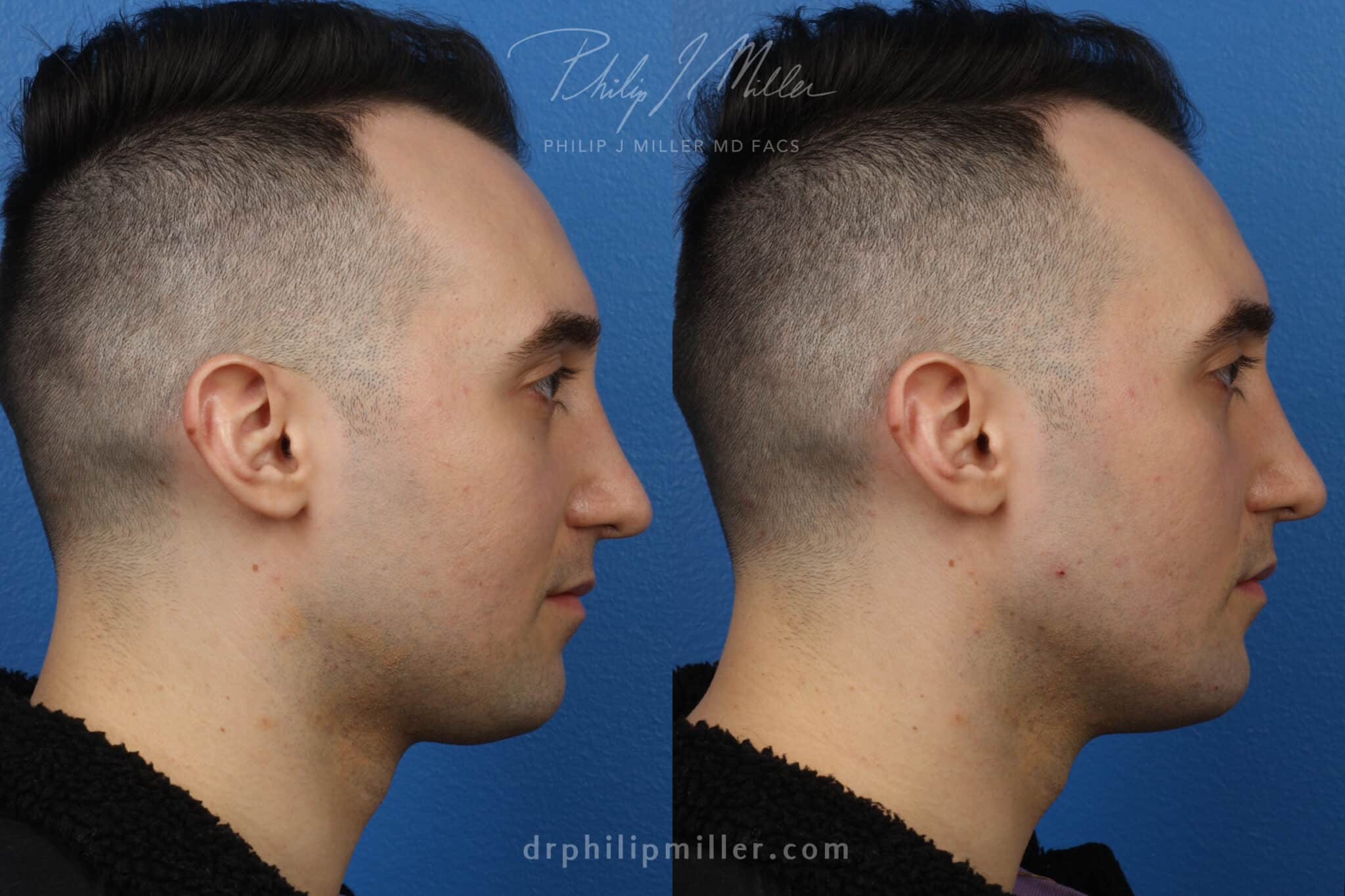 GI Jaw for jaw enhancement by Dr. Miller. Surgery creates stronger, more masculine jawline.