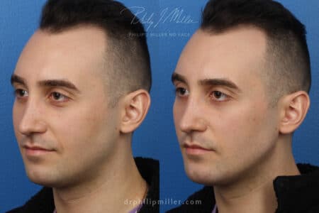 GI Jaw for jaw enhancement by Dr. Miller