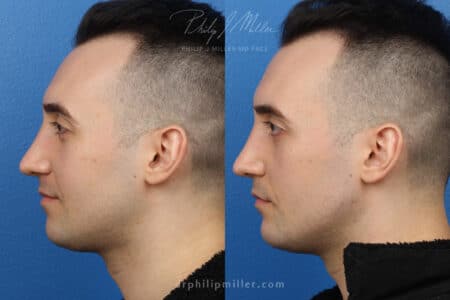 GI Jaw for jaw enhancement by Dr. Miller