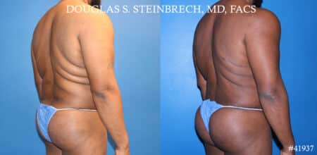 Liposuction and body banking to sculpt torso by Dr. Steinbrech