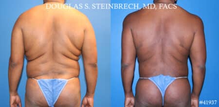 Liposuction and body banking to sculpt torso by Dr. Steinbrech