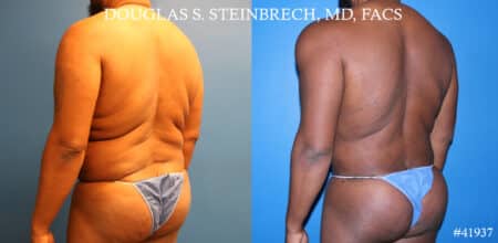 Liposuction and body banking to sculpt torso by Dr. Steinbrech