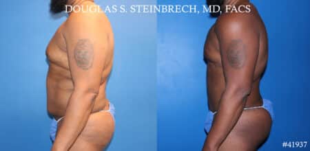 Liposuction and body banking to sculpt torso by Dr. Steinbrech