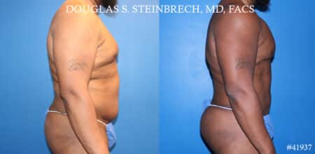 Liposuction and body banking to sculpt torso by Dr. Steinbrech