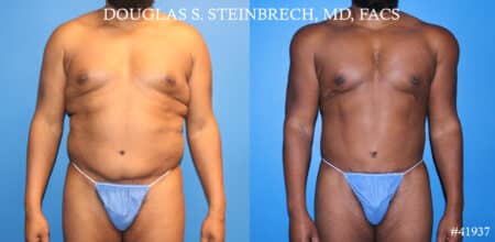 Liposuction and body banking to sculpt torso by Dr. Steinbrech