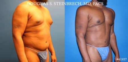 Liposuction and body banking to sculpt torso by Dr. Steinbrech