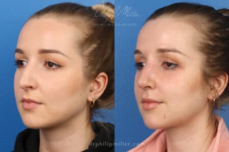 Rhinoplasty to remove hump from nasal bridge, one week later, by Dr. Miller