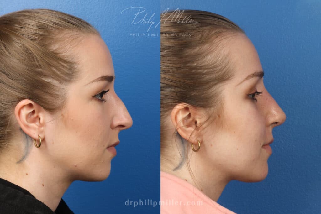 Rhinoplasty to improve nasal bridge and tip, 1 week post-op, by Dr. Miller. After surgery, nasal hump is gone and tip is slightly rotated.