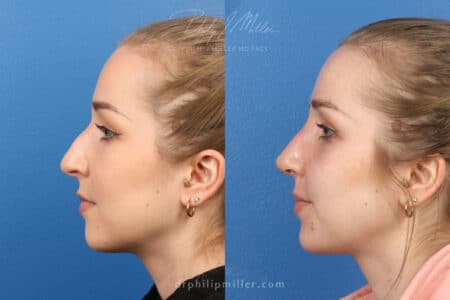 Rhinoplasty to remove hump from nasal bridge, one week later, by Dr. Miller