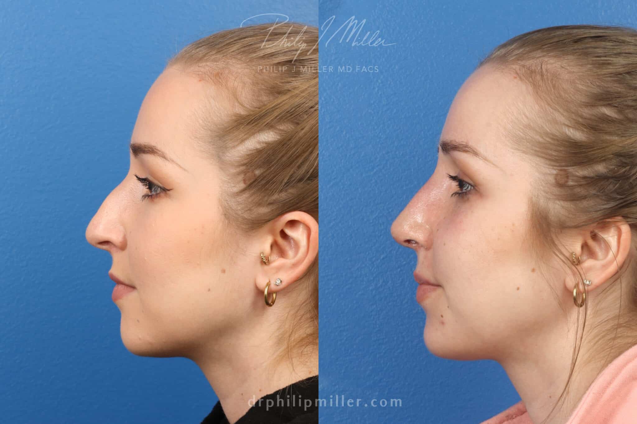 Rhinoplasty to improve nasal bridge and tip, 1 week post-op, by Dr. Miller. After surgery, nasal hump is gone and tip is slightly rotated.