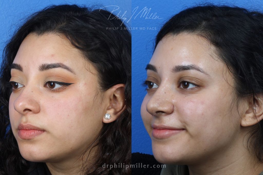 Rhinoplasty to improve nose by Dr. Miller. Surgery refines nasal bridge and tip for a more aesthetically pleasing profile.