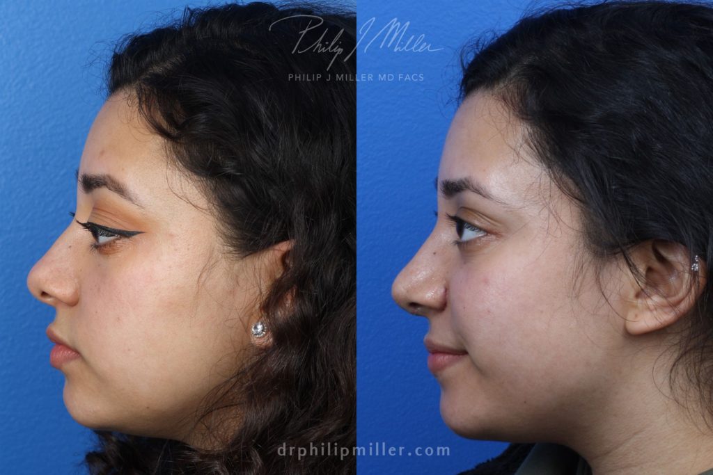 Rhinoplasty to improve nose by Dr. Miller. Surgery refines nasal bridge and tip for a more aesthetically pleasing profile.