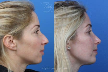 Rhinoplasty to straighten nasal bridge by Dr. Miller