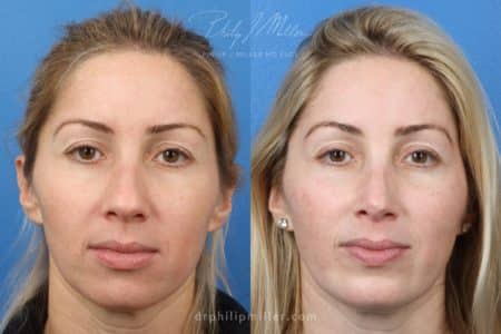 Rhinoplasty to straighten nasal bridge by Dr. Miller