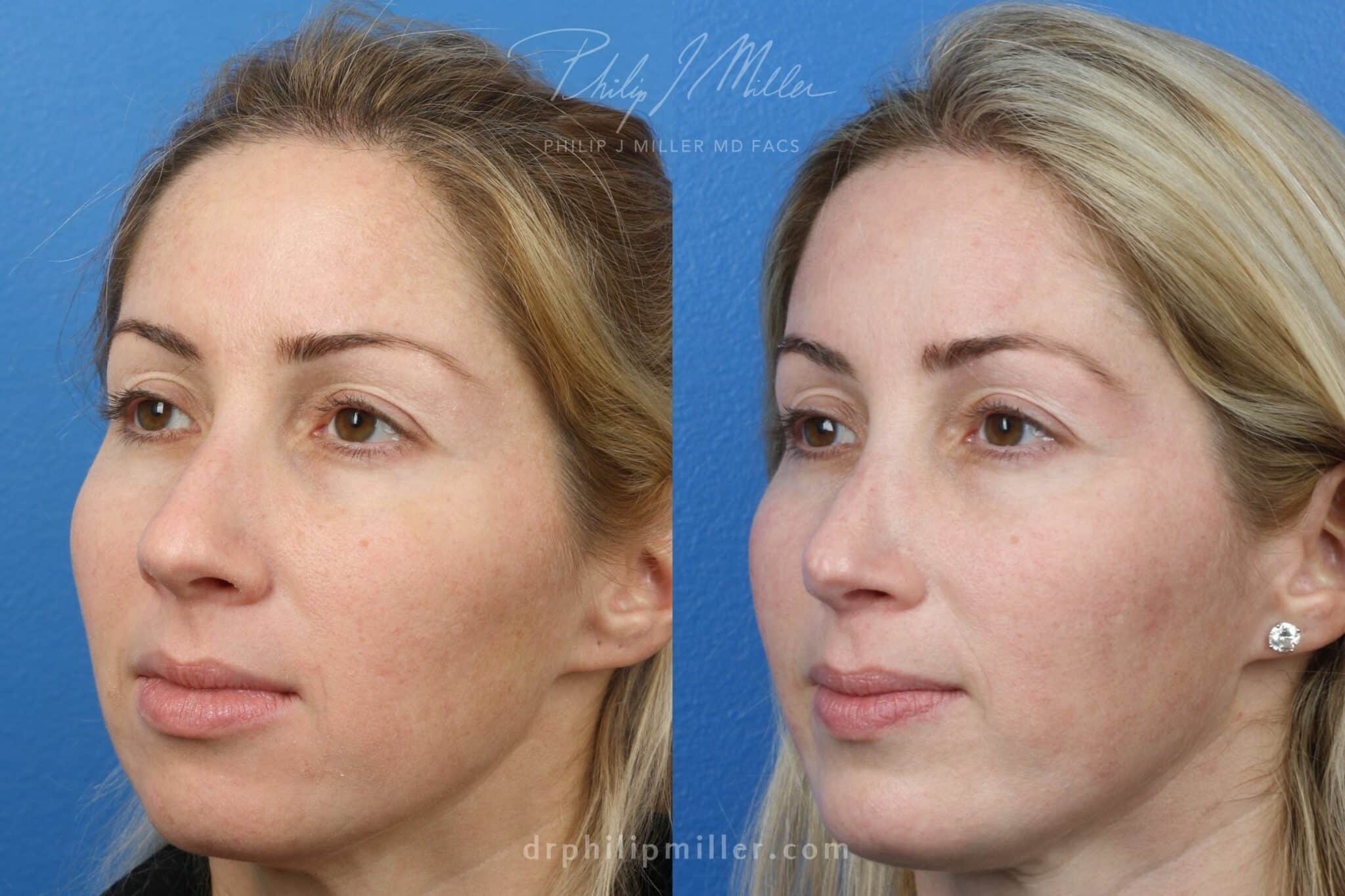 Rhinoplasty to straighten nasal bridge by Dr. Miller. Surgery removes hump from nasal bridge for a more aesthetically pleasing profile.