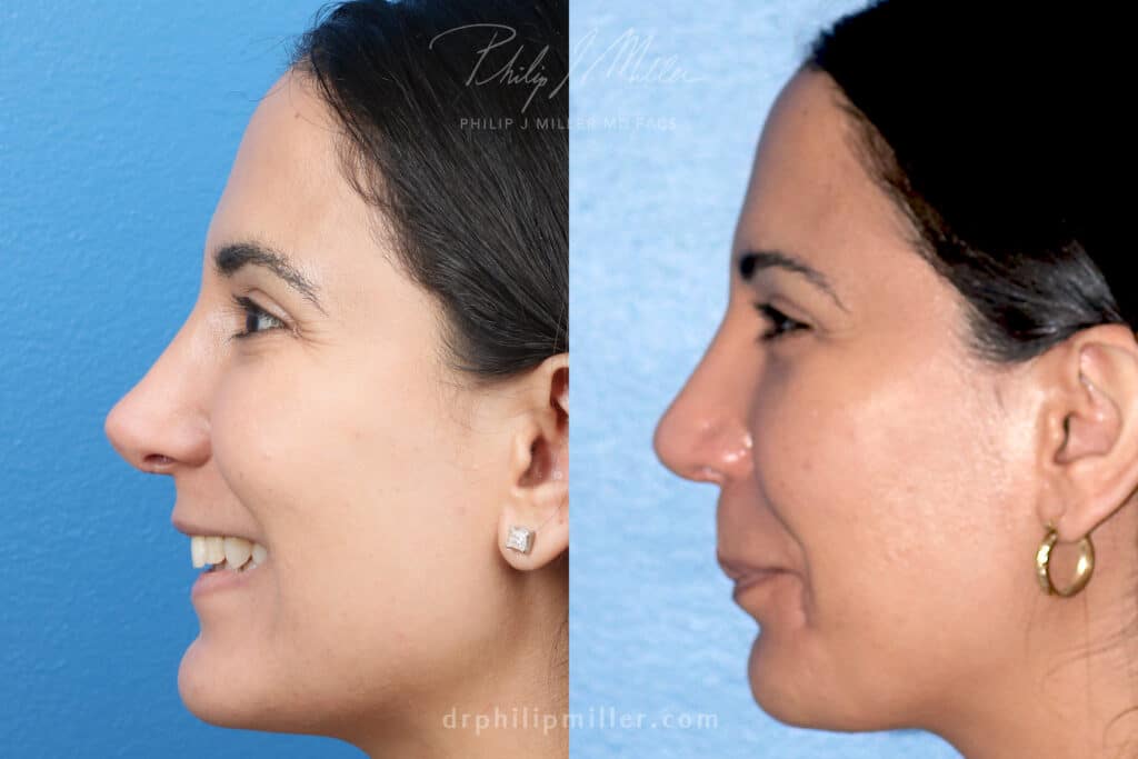 Rhinoplasty to refine the tip by Dr. Miller. After surgery, nasal tip is less pointed and creates a more aesthetically-pleasing profile.