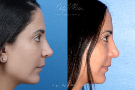 Rhinoplasty to refine nasal tip by Dr. Miller