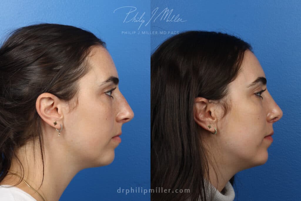 nose job results in Manhattan, NY