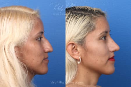 Rhinoplasty to remove hump from nasal bridge – 3 months post-op – by Dr. Miller