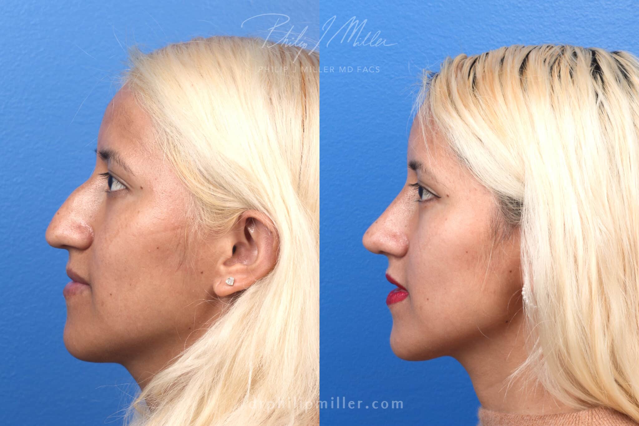 Rhinoplasty to remove hump from nasal bridge and refine the tip by Dr. Miller. Three months after surgery, dorsal hump is removed and tip is slightly rotated and refined.