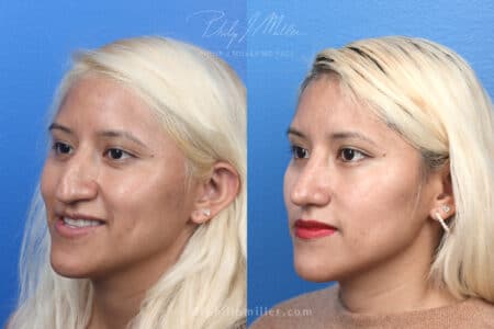 Rhinoplasty to remove hump from nasal bridge – 3 months post-op – by Dr. Miller