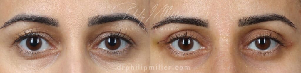 Upper blepharoplasty to eliminate eyelid hooding by Dr. Miller. After surgery, eyes look refreshed with a higher crease in the upper lid.