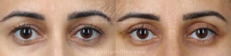 Upper blepharoplasty to treat eyelid hooding by Dr. Miller