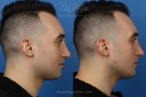 chin augmentation for men in Manhattan, NY