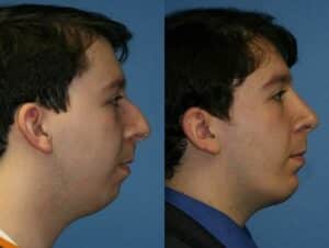 necklift surgery on male patient to contour the neck and jawline in NYC, NY