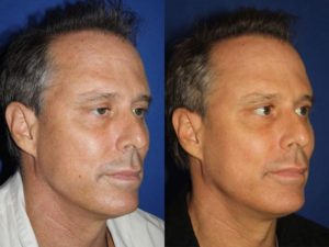 non-surgical anti-aging treatments for men in NY, NY