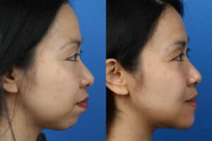 surgical chin augmentation in NY, NY