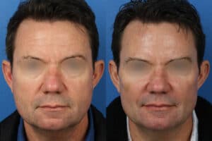 surgical anti-aging treatments for men in New York City