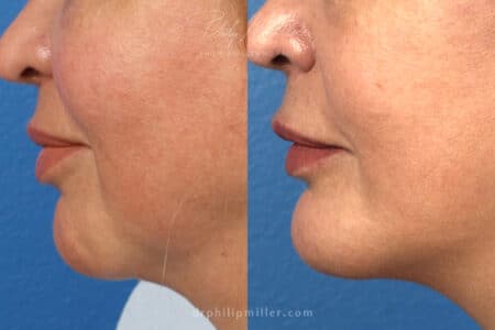 Chin implant to increase projection of chin by Dr. Miller