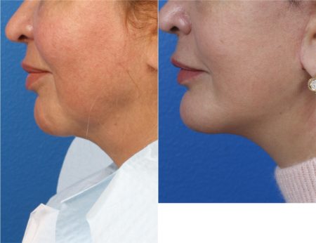 Chin implant to increase projection of chin by Dr. Miller