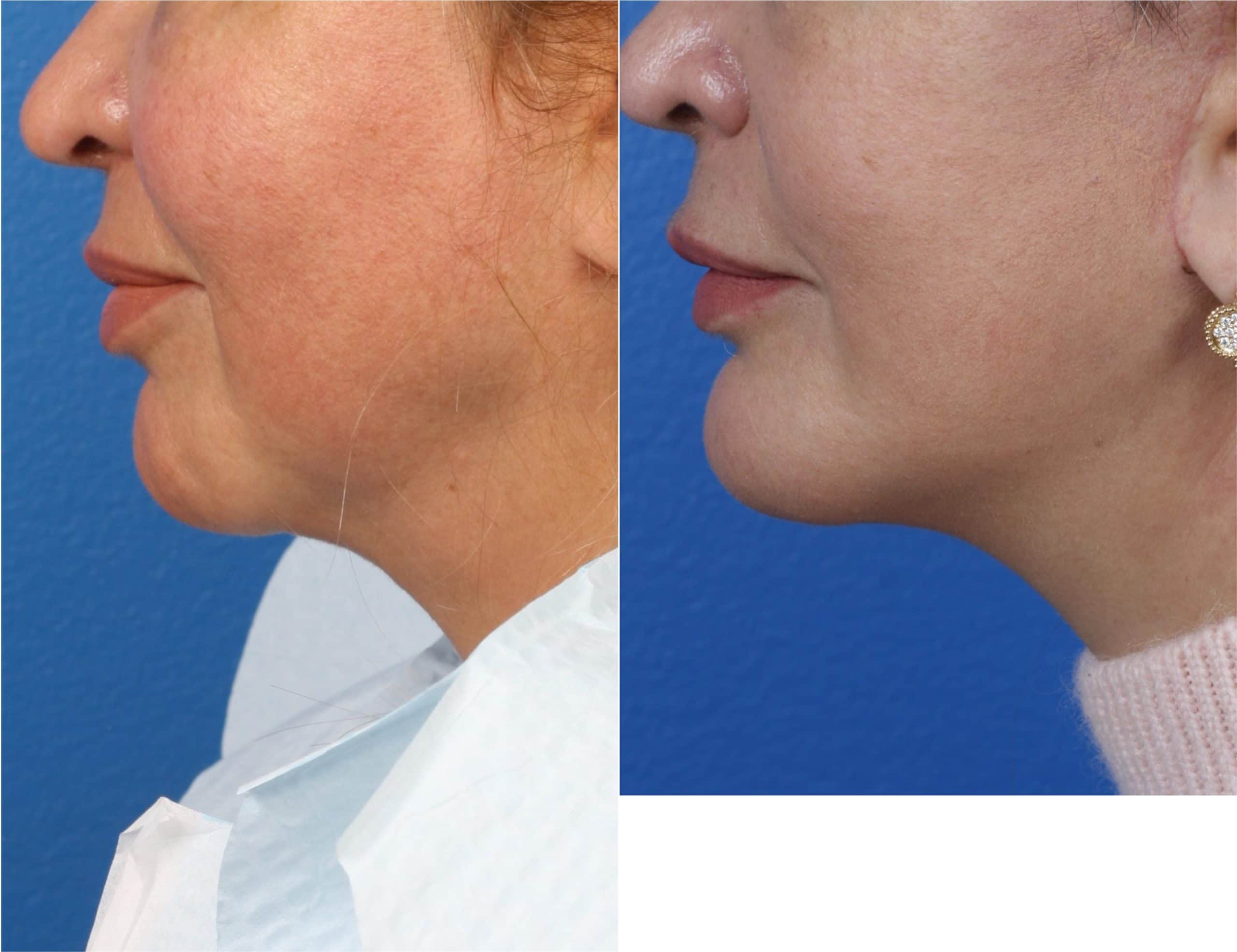 Chin implant to increase projection of chin by Dr. Miller. After surgery, chin is proportionate to other facial features for a more aesthetically pleasing facial profile.