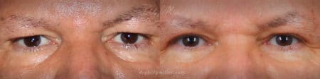 Upper blepharoplasty to treat eyelid hooding by Dr. Miller