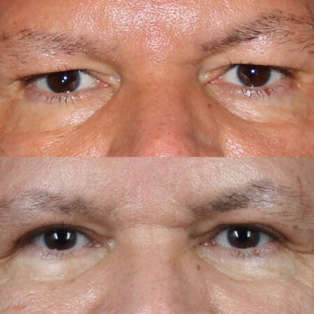 Upper blepharoplasty to treat eyelid hooding by Dr. Miller
